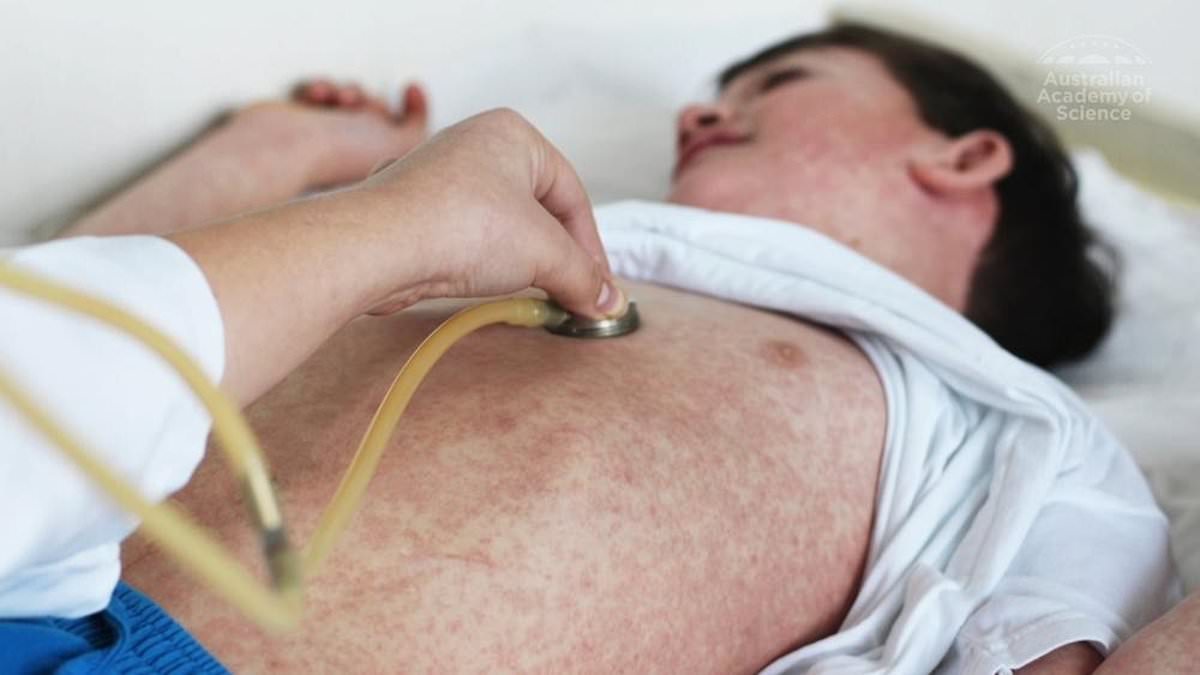 Revealed: Little-known 'first' sign of deadly measles that's 'often missed' - would you spot it?